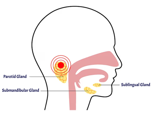 Salivary Gland Disorders
