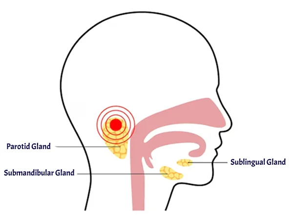 Salivary Gland Disorders
