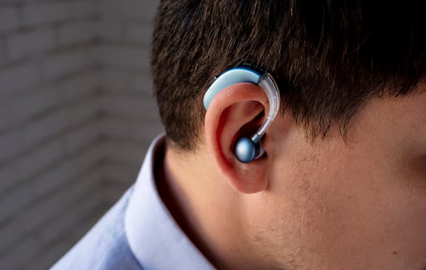 Cochlear Implantation and Bone Anchored Hearing Aids